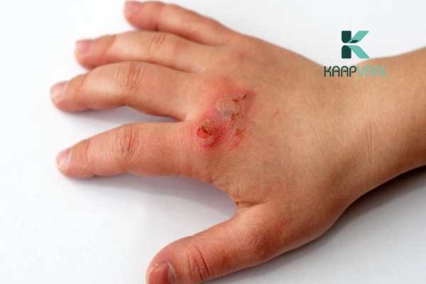 Cách trị sẹo bỏng dầu ăn tại nhà cải thiện nhanh chóng