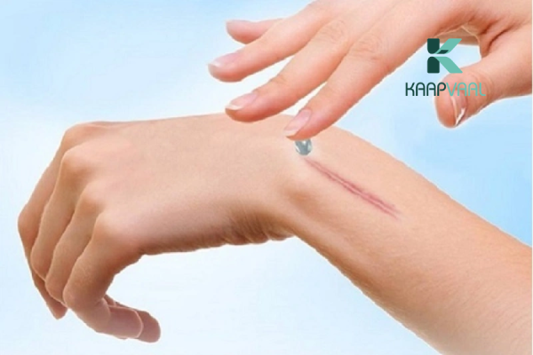 Sẹo lồi bôi thuốc có hết không?