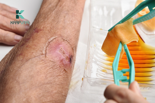 Vết thương mãn tính