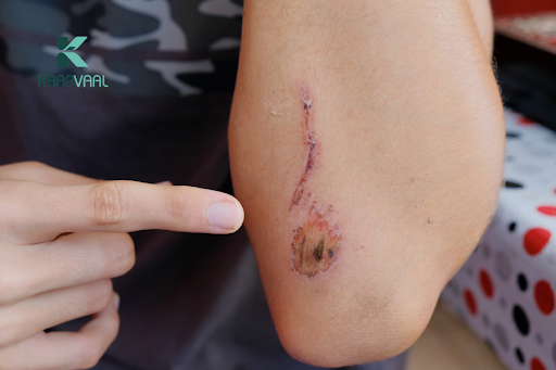 Vết thương lâu lành