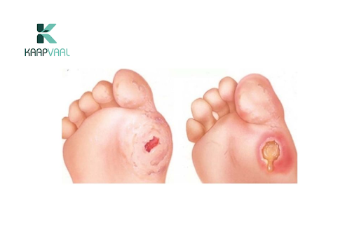 Bí quyết chăm sóc và điều trị vết thương lở loét hiệu quả