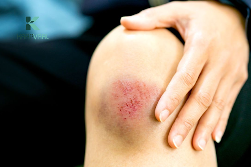 Xử lý thế nào khi bị vết thương ở đầu gối?