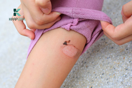 Bỏng bô có để lại sẹo không?