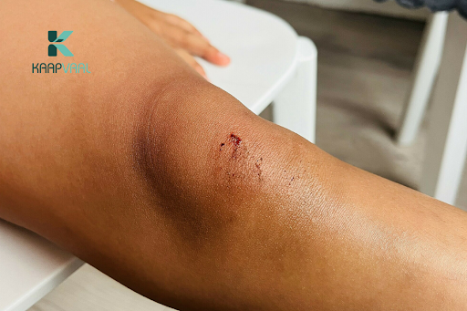 Nguyên nhân vết thương bị rát