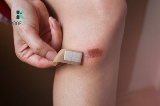 Vết thương lên da non bị đỏ bao lâu thì hết? Chăm sóc thế nào?