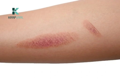 Cách nhận biết vết thương lên da non