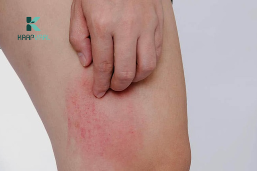 Cách giảm ngứa khi lên da non