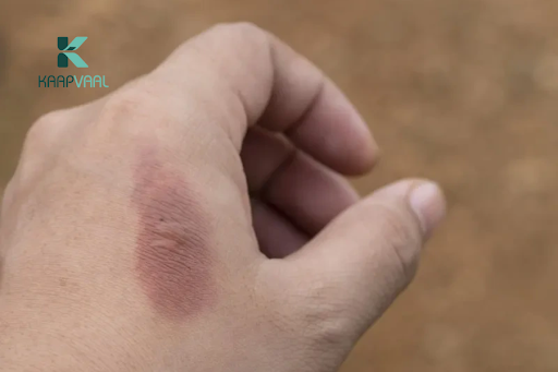 Vì sao vết thương lên da non bị thâm?