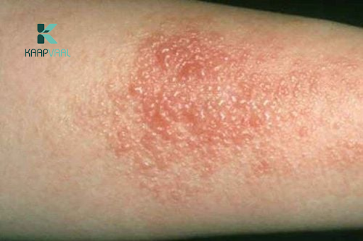 Vết thương lên da non nổi mụn nước có sao không?