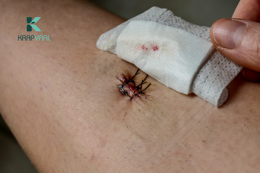 vết thương bị bung chỉ