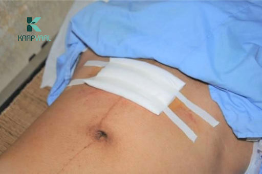 Vết thương khâu có nên băng kín không?