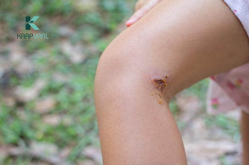 Vết thương chảy mủ có sao không?