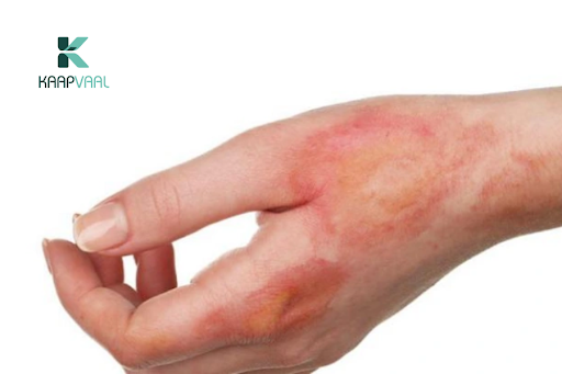 Sẹo bỏng có hết không?