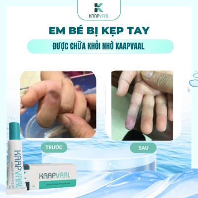 Em bé bị kẹp tay được chữa khỏi nhờ Kaapvaal