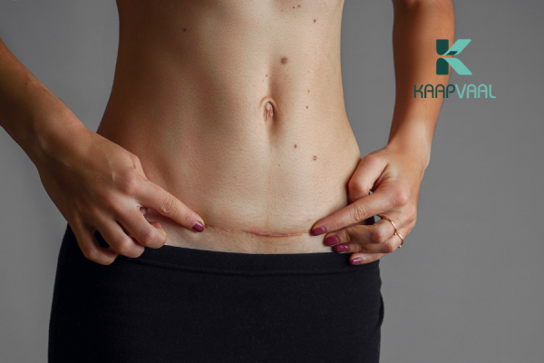 trị sẹo lồi sau sinh mổ
