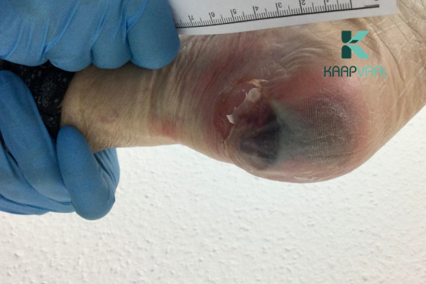 Hoại tử da do tì đè