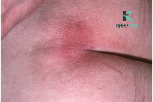 Dấu hiệu nhận biết sớm loét tì đè