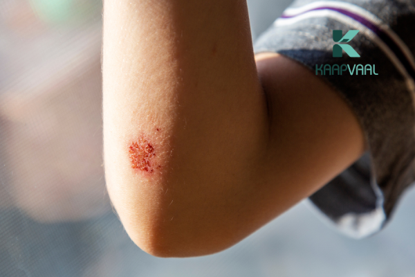 cách làm vết thương hở mau khô