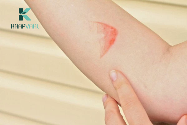 Bỏng cấp độ 1