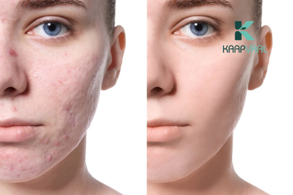 phương pháp điều trị sẹo lõm