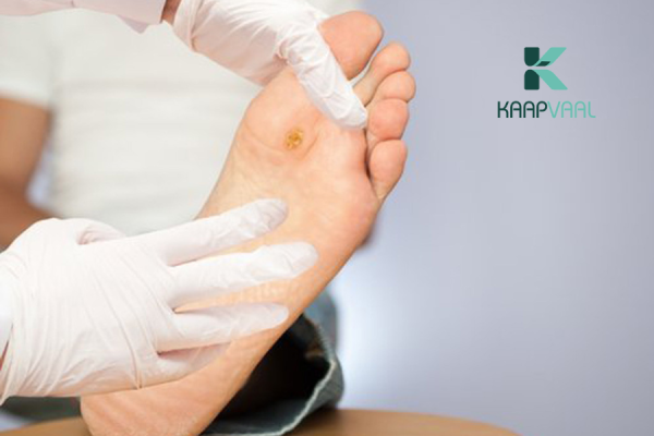 Tiểu đường vết thương không lành