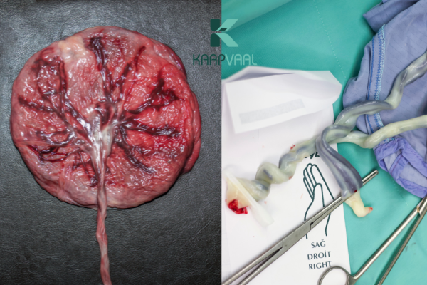 tế bào gốc từ nhau thai và dây rốn