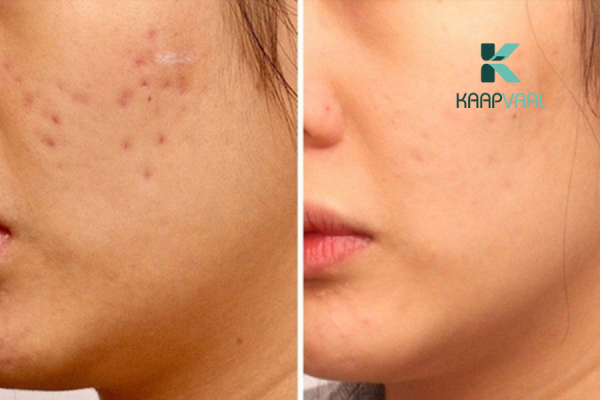 Hướng dẫn cách trị sẹo lõm thủy đậu