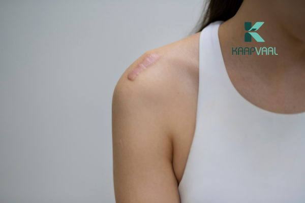 trị sẹo lồi ở trẻ em