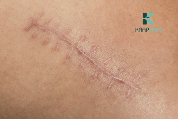 thuốc trị sẹo sau phẫu thuật