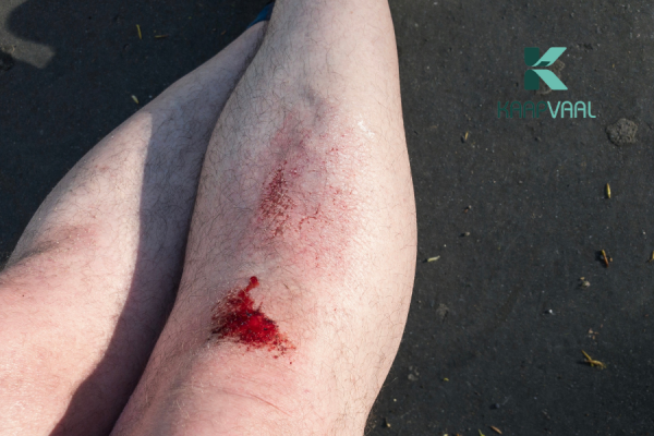 Vết thương ngoài da