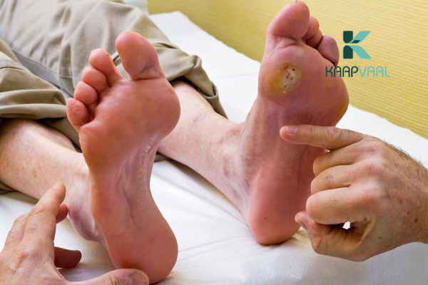 Loét bàn chân tiểu đường có chữa khỏi không?