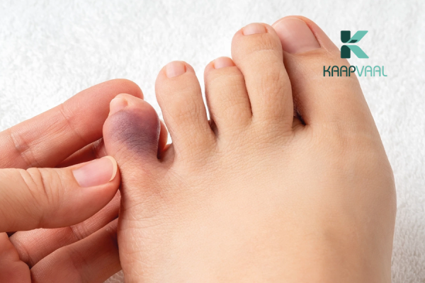 Loét tiểu đường bao lâu thì lành?