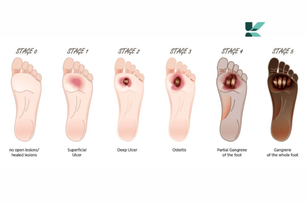 Phân loại loét bàn chân tiểu đường theo Wagner