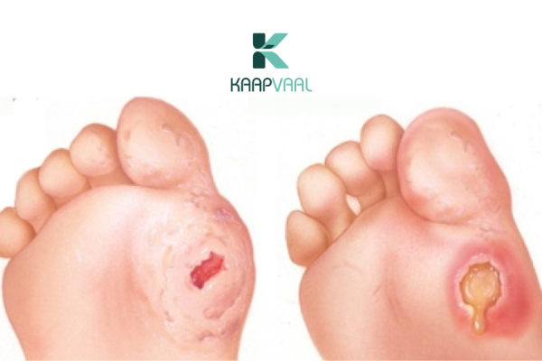 Dấu hiệu nhận biết loét tiểu đường