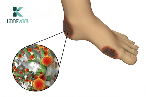 Kỹ thuật cắt lọc mô hoại tử trong loét tiểu đường