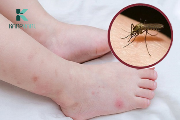 thuốc trị vết thâm muỗi đốt