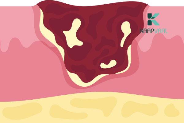 Loét tỳ đè sống được bao lâu?