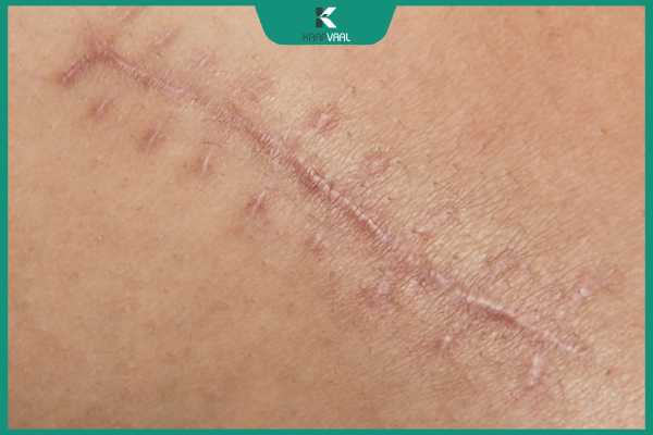 vết sẹo phẫu thuật